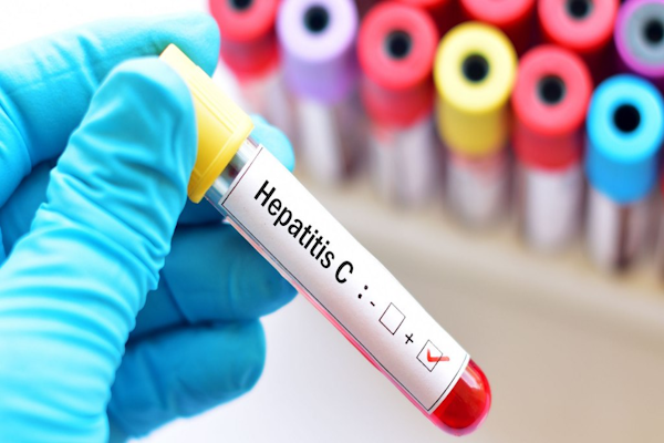 8 de cada 10 personas con hepatitis C aún no se trataron para curarse. - Foto: Agencia NA